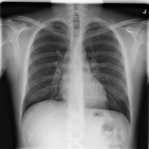 Normal chest X-ray